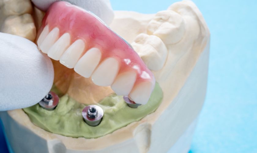 Affordable Dental Implants In 2024